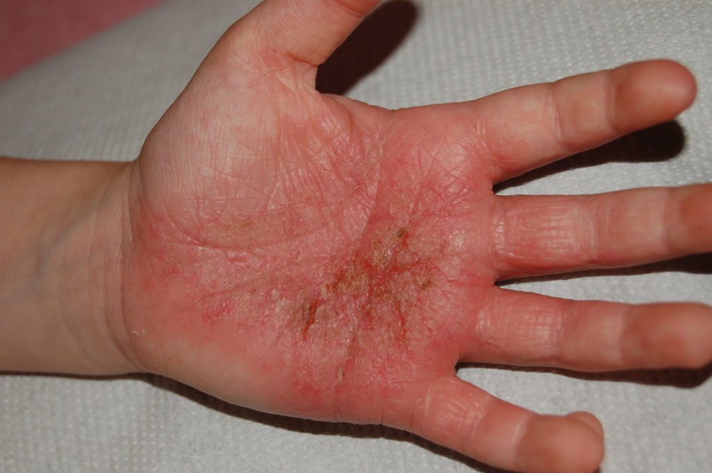Cours aromathérapie allergies & dermatologie | Naturopathie ...