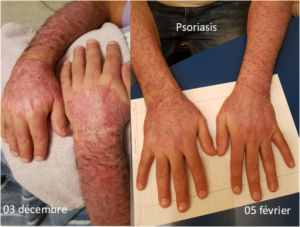 Psoriasis et chromatothérapie